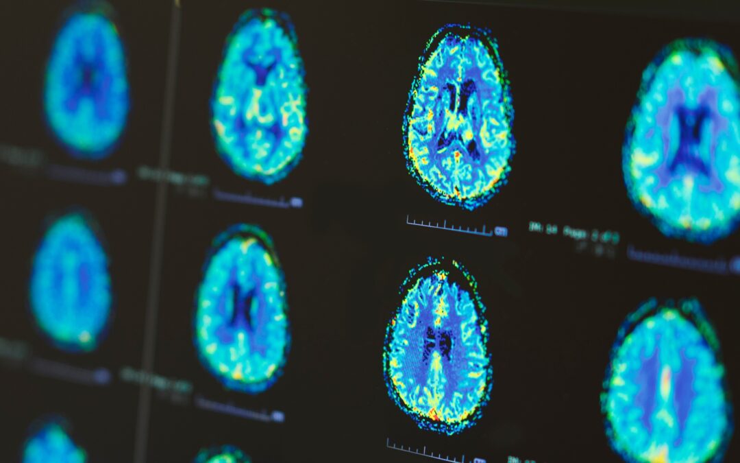 AI Tools Offer Improved Diagnosis via Brain Images