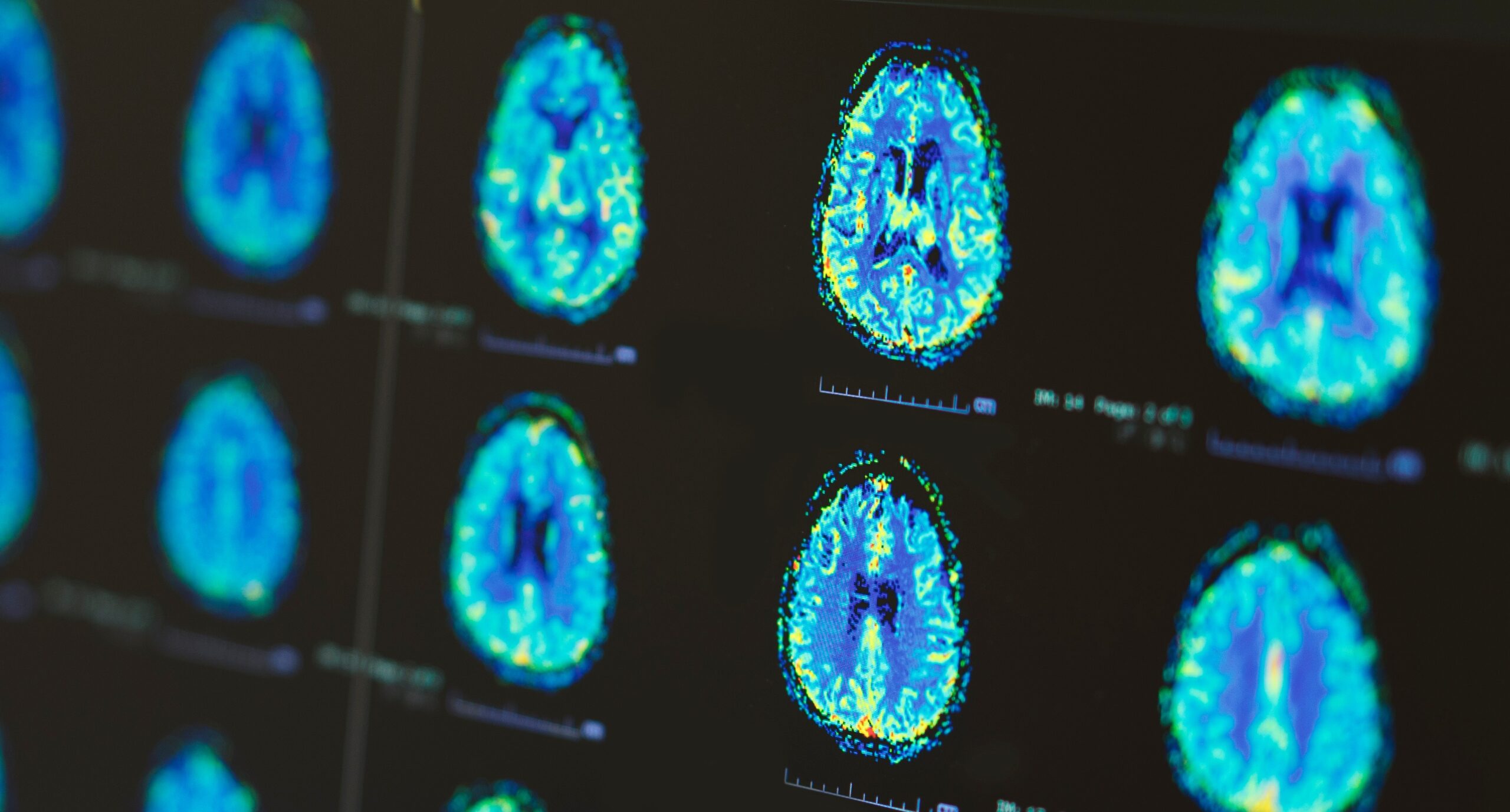 Brain scans shown in a spectrum of colors. 